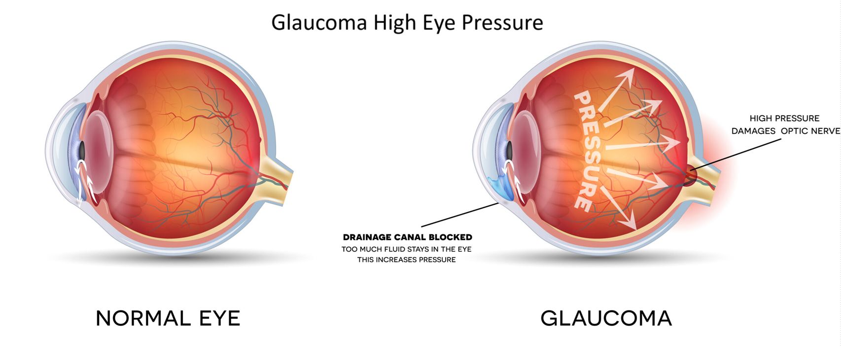 Glaucoma High Eye Pressure